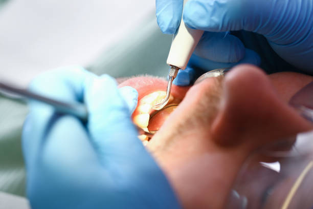 Best Emergency Tooth Extraction in Ecorse, MI